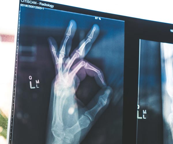 X-ray of hand with bones